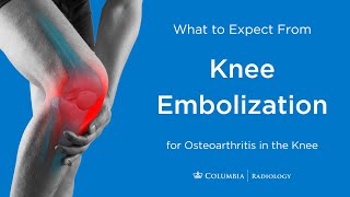 Knee Embolization For Osteoarthritis
