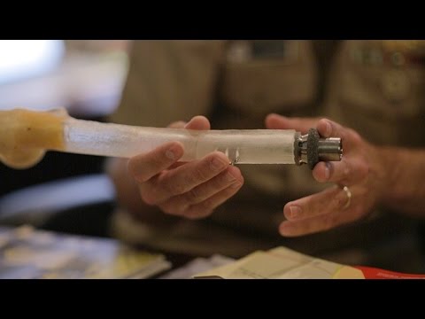 Orthopaedic Osseointegration Prosthetic