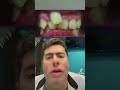 Χαμογελάστε τώρα,όχι σε χρόνια!Κάνε subscribe & χτύπα το καμπανάκι!🔔 #drevangelosviazis #fastbraces