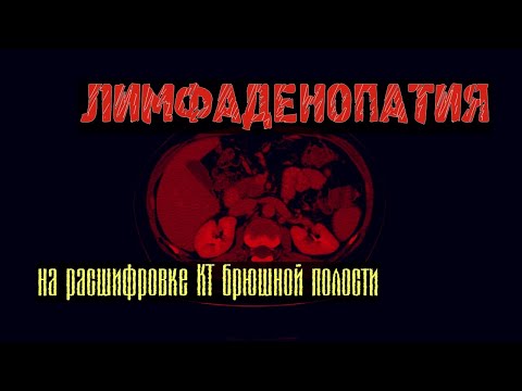 Video: Lymfadenopatia - Hoito, Kohdunkaulan Ja Kainalon Lymfadenopatia