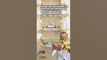 Lumbar Disc REPLACEMENT Do’s and Dont’s