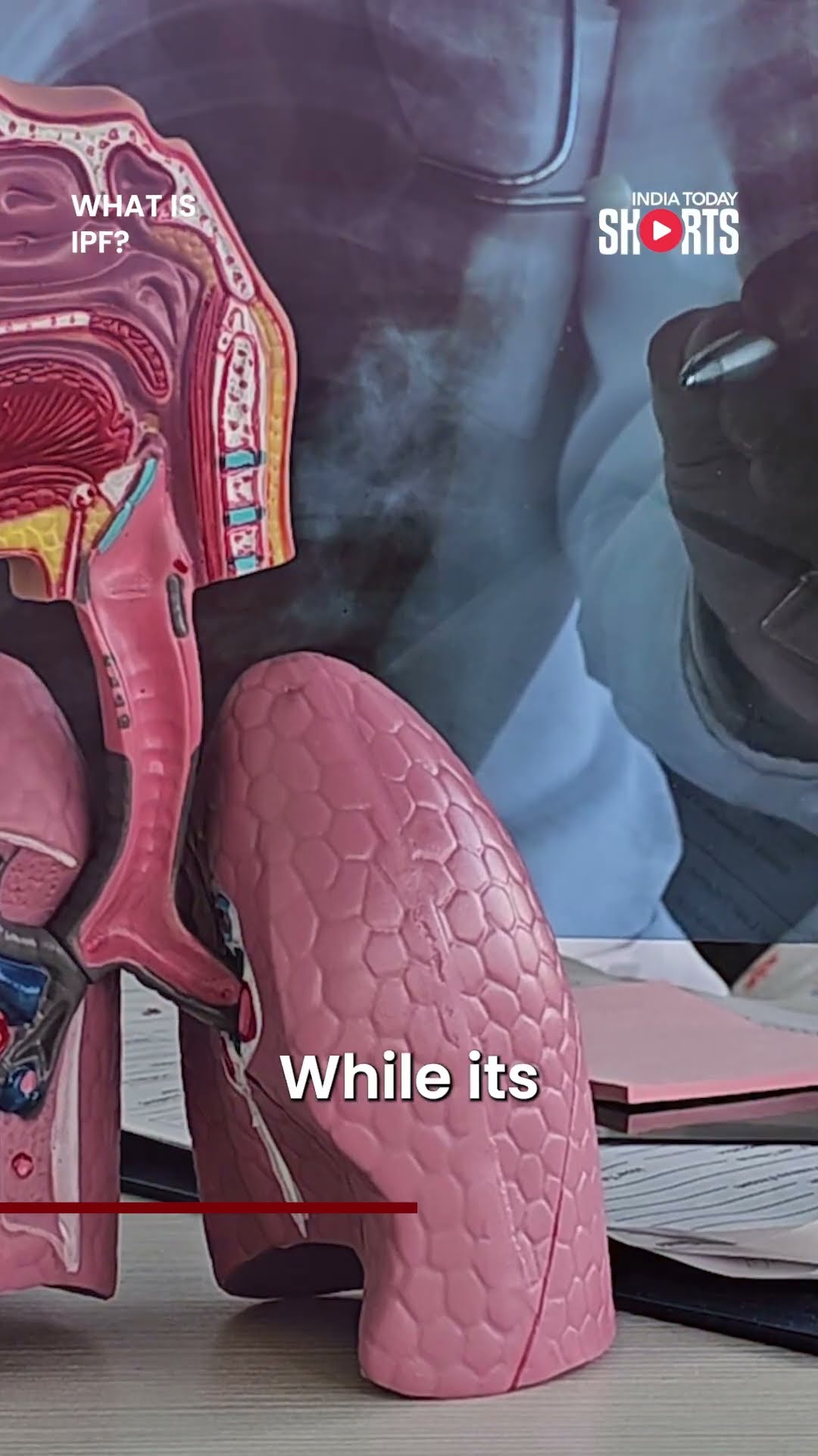 Idiopathic Pulmonary Fibrosis: The Lung Condition Zakir Hussain Was Suffering From