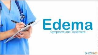 Perimaleolar bilateral edema