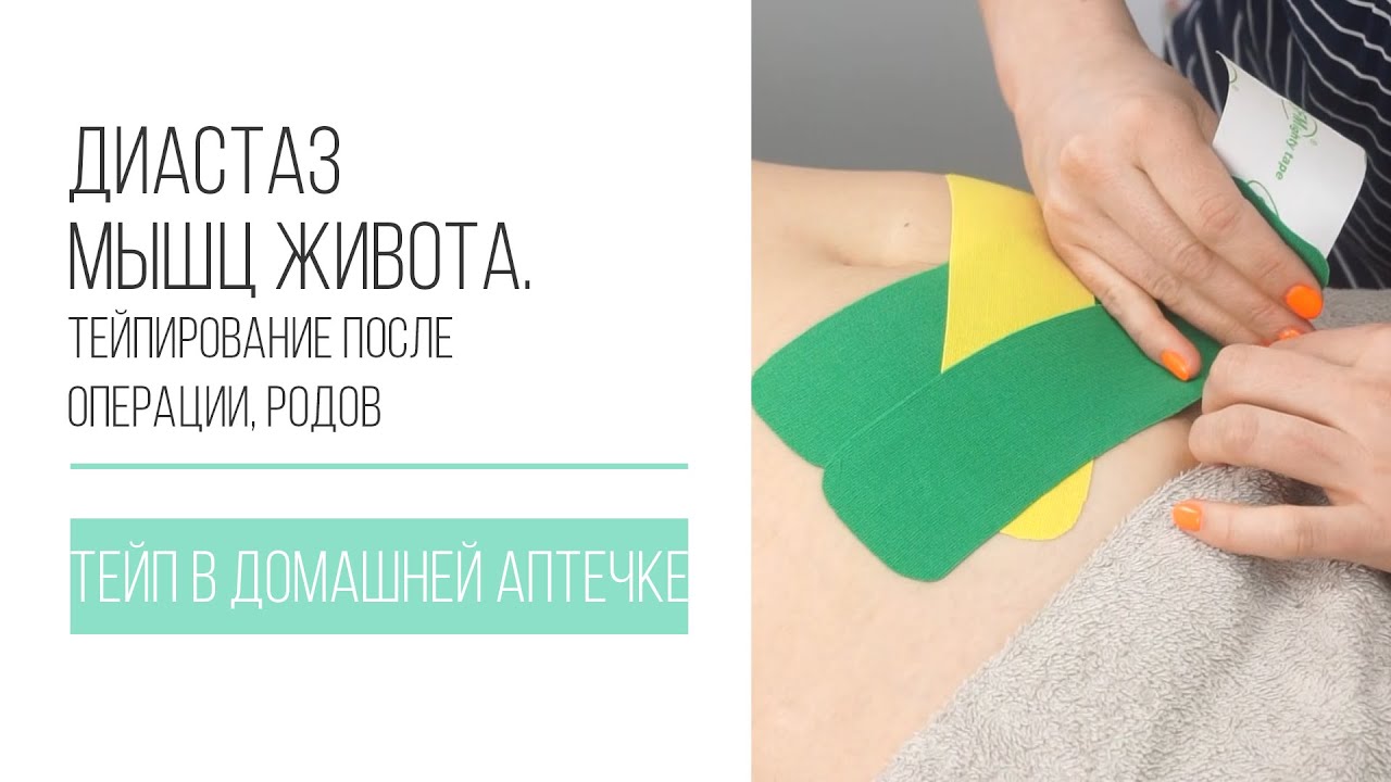 Тейпирование после кесарева сечения схема