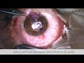 Like procedure performed by prof sunil shah birmingham uk for treatment of advanced keratoconus