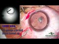 Best for posterior polar cataract surgery technique  dr kamal b kapur sharpsight