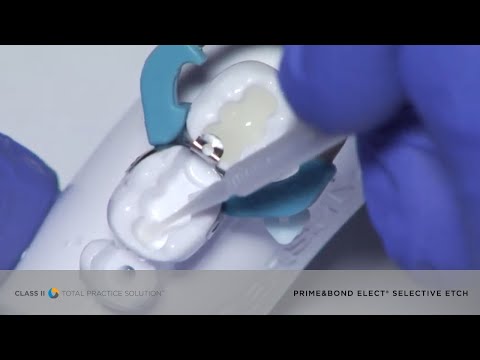 Dental Bonding Tips: Selective-Etch with Prime&Bond® elect | Dentsply Sirona