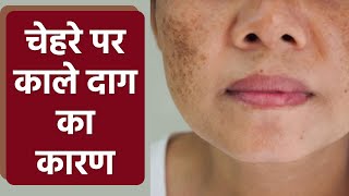 चहर पर कल दग कय हत ह चहर पर कल दग हन क करण Boldsky Health