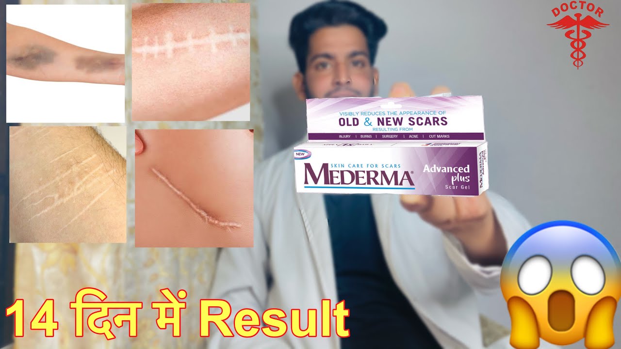 Mederma advanced scar gel review Mederma cream kaise use kare