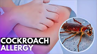 Cockroach Allergy Unmasked: Symptoms, Diagnosis, and Treatment