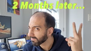 2 month Hair Transplant Update from Turkey! / Taking Finasteride