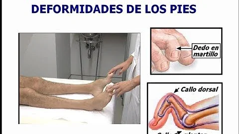 ¿A qué grupo de edad afecta la enfermedad de Charcot-Marie-Tooth?