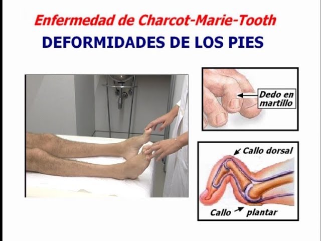 Enfermedad de Charcot-Marie-Tooth - YouTube