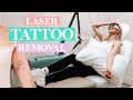 Getting my first tattoo removed