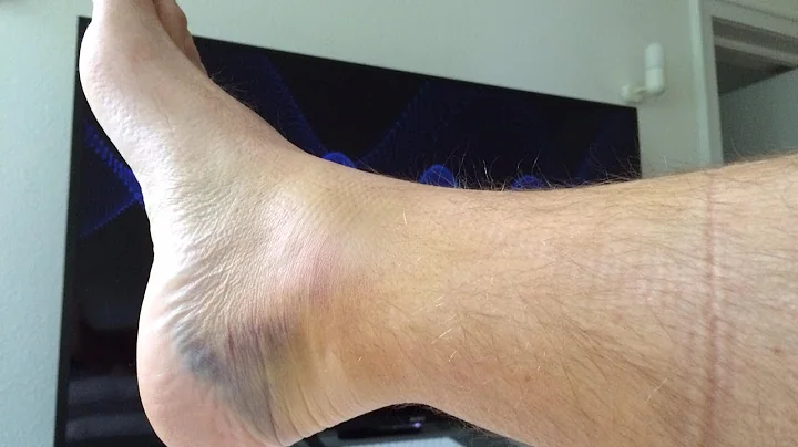 Achilles Tendon Recovery #1-non-surgical, early we...