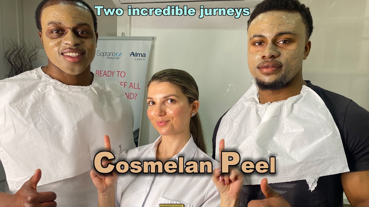 Cosmelan Peel Full Demo + closer look at the most important first 2 weeks after the peel (2022)