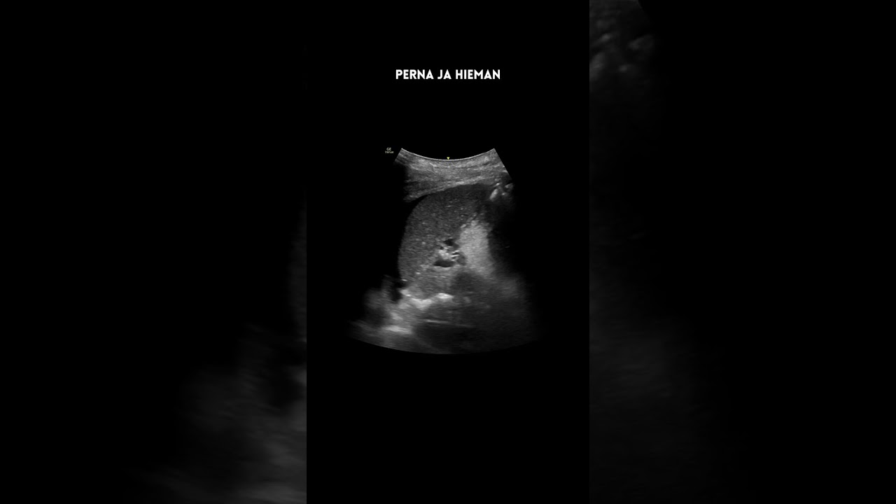 eFAST on traumapotilaan ensiarvion ultraäänitutkimus