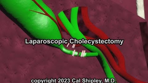 Cholecystectomy by Cal Shipley, M.D.