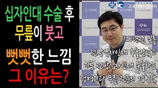 무릎 수술 후 뻑적지근하고 관절이 붓는 느낌, 강직되는 느낌 괜찮은건가요 (전방십자인대 수술 후 불편한 이 느낌)