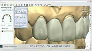Full anatomy bridge design