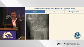 Виктор Мельников: неправильно сросшиеся переломы и повреждение TFCC, SL связки.