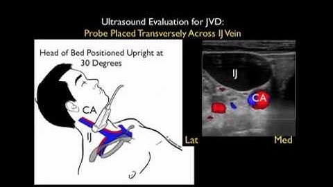 How to Case Study: RUSH Exam Video Part 3 - SonoSite, Inc