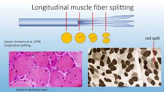 Myopathy Lecture - Advanced