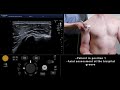 Ultrasound tutorial msk series shoulder  rotator cuff  radiology nation