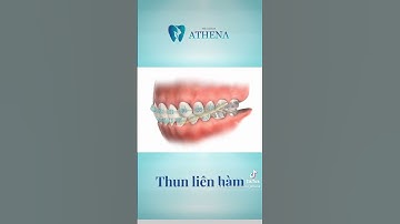 Thun liền hàm là gì? #nhakhoa #dentist #dentalbraces