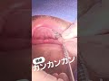 銀歯のやり直しです。ありがたいことにほぼ毎回金属の除去をした歯のセラミックを担当しております。お口の中の金属が気になる方もダイヤモンド今井にお任せくださいませ#セラミック #銀歯#セラミック矯正
