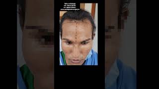 Facial Feminization Surgery In India Chennai Mumbai Nagpur Bangalore Patna Jodhpur Nagpur Goa Ujjain