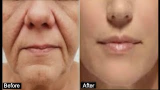 HOW TO REMOVE DEEP MOUTH WRINKLES REALLY FAST