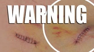 WARNING: GRAPHIC CONTENT - My Skin Cancer Scare