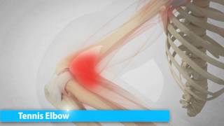 SportVis™ Short Video Soft Tissue Indications screenshot 2