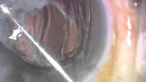 Management of a Soemmerring Ring and Dislocated Sulcus IOL