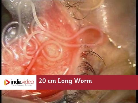 20 cm Long Worm In The Human Eye, First Ever Recorded On Video | India Video