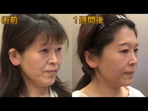 【鼻翼基部プロテーゼ（貴族手術）④/4】手術後1週間の状態。まだ少し腫れています。