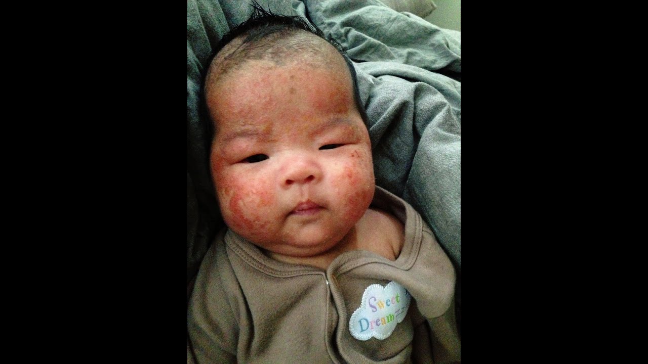 BB濕疹患者玫瑰痤瘡皮膚癢救星 — 芫荽水 Coriander bath for Eczema Baby YouTube