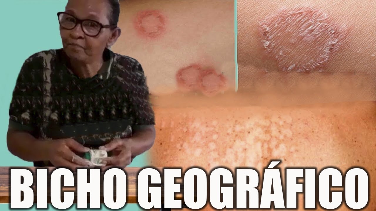 O MELHOR Remédio caseiro para bicho geográfico e Remédio caseiro para ...