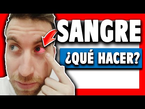 Video: Maneras seguras y efectivas de curar un vaso sanguíneo reventado en su ojo