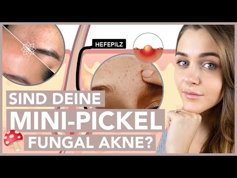 Video: Pityrosporum Folliculitis: Natürliche Behandlung, Gesicht Und Mehr