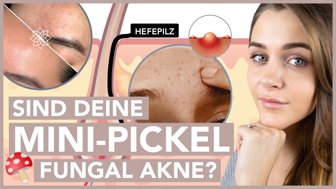 Pickel Auf Der Stirn Das Hilft Bei Fungal Akne Youtube