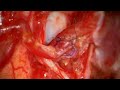 Far Lateral Craniotomy for Excision and Reimplantation of a Ruptured PICA Aneurysm