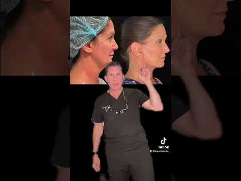 Deep Plane Facelift