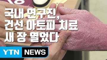 [자막뉴스] 국내 연구진, 건선·아토피 치료 새 장 열었다 / YTN