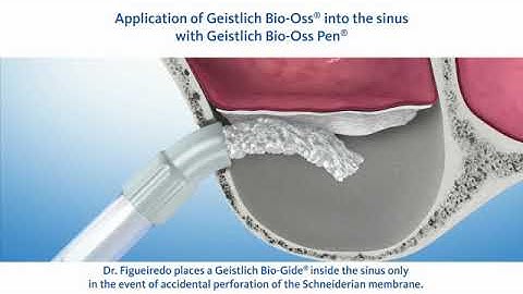 Sinus Floor Elevation - DDS, MSc, PhD Rui Figueiredo & DDS Jose Leonardo Carabello