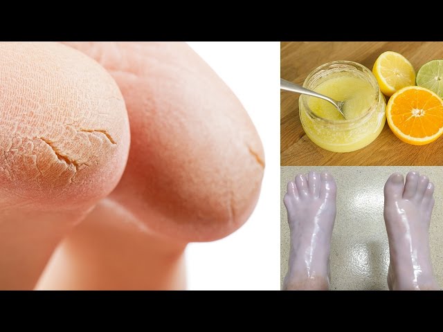 Top 5 Home Remedies To Fix Cracked Heels; Know Tips To Prevent Dry And Cracked  Heels