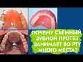 Базис съемного зубного протеза. От чего зависит его размер?