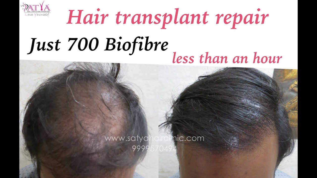 Artificial Hair Fibers Biocompatible Artificial Hair Biofibre hair implant  in Delhi