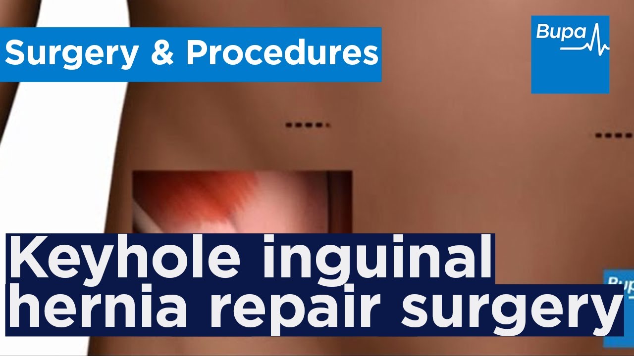 How keyhole inguinal hernia repair surgery is carried out | Bupa